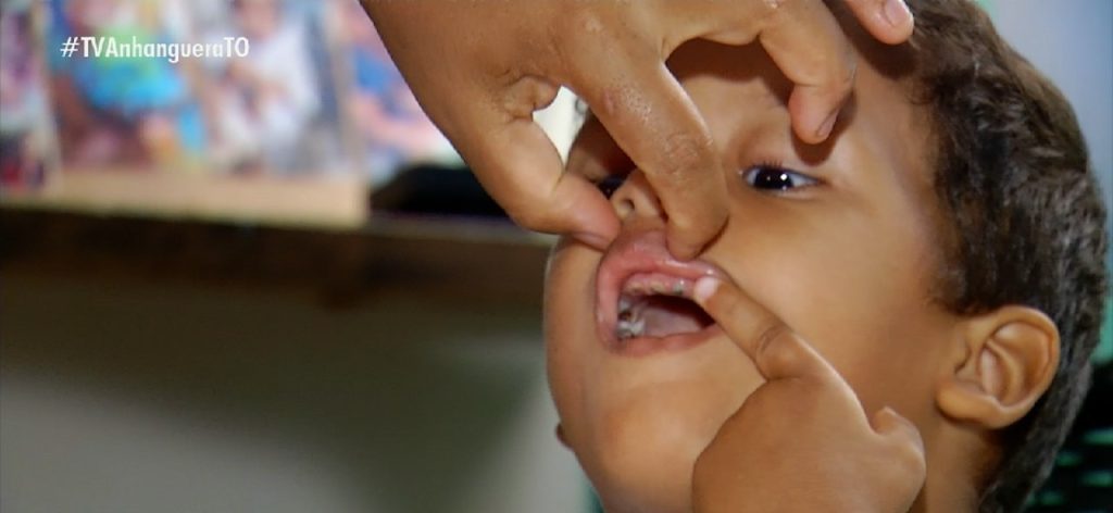 Menino de três anos com cárie teve 14 dentes arrancados em cirurgia: ‘Conseguiram restaurar 11’, diz mãe